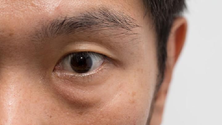 儿童患红眼病有哪些症状?