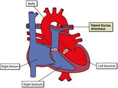 动脉导管未闭的诊断标准是什么呢