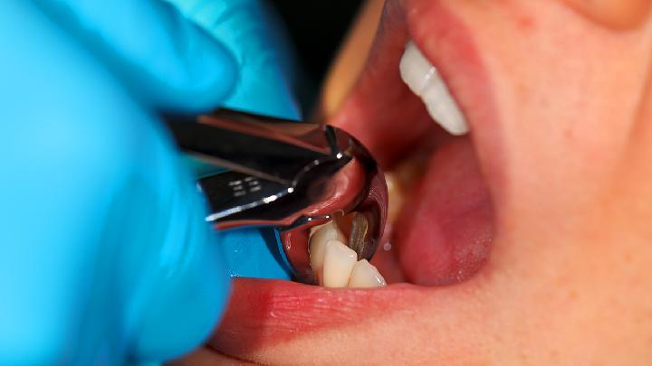 引发急性牙髓炎的常见原因