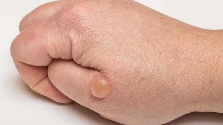 湿疹患者通常有什么症状和表现呢