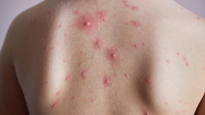 简述湿疹的临床表现有哪些