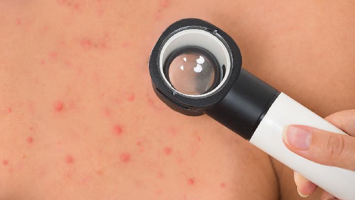 治疗湿疹常见的方法有哪些