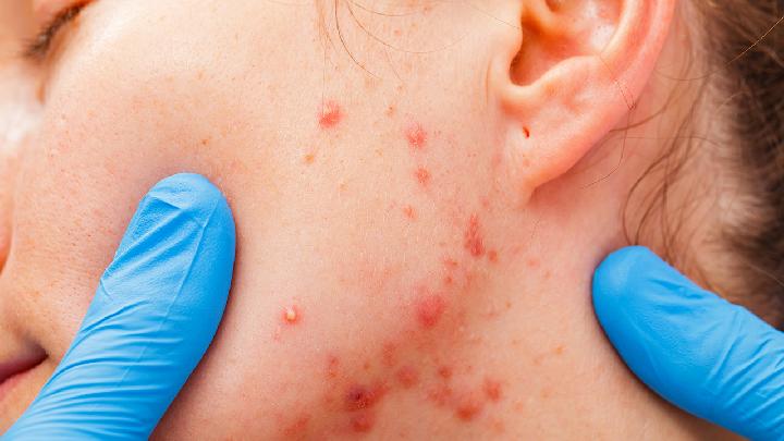 预防湿疹要掌握什么方法
