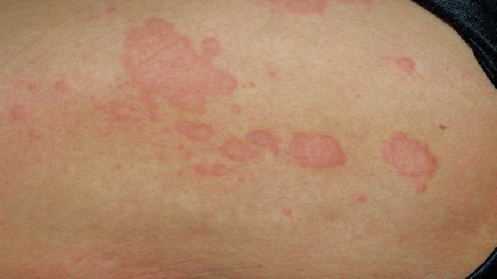 不同类型的湿疹初期有什么症状表现?