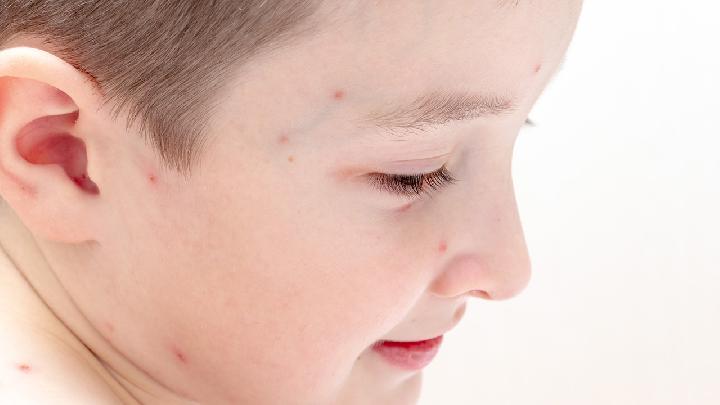 宝宝有哪些症状表明湿疹出现了