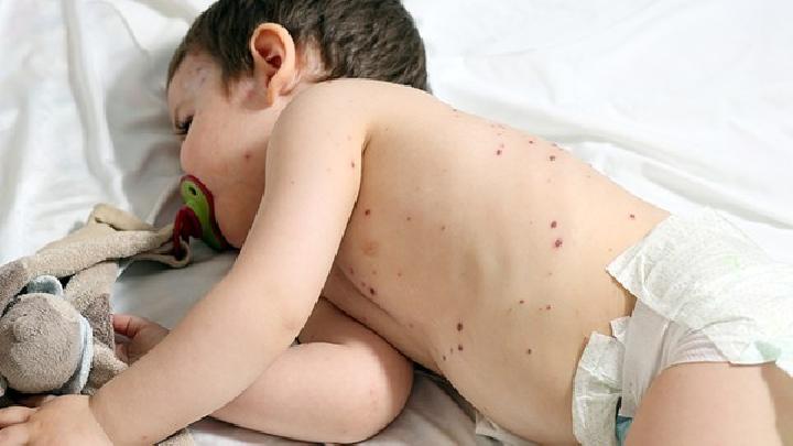 预防儿童湿疹应该怎么做呢