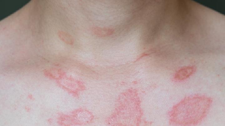 怎样才能减轻湿疹的危害?