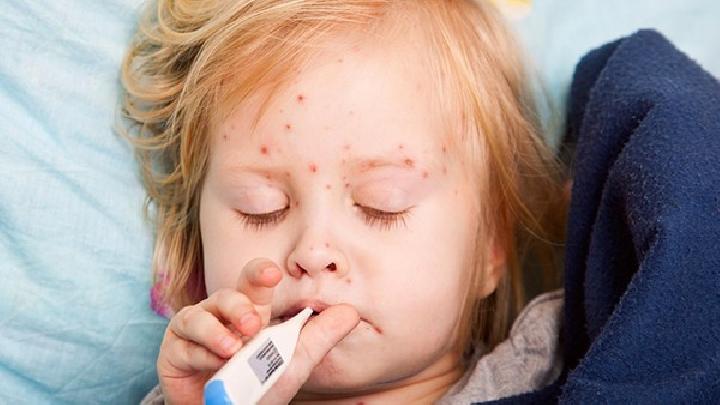 湿疹的预防方法是什么
