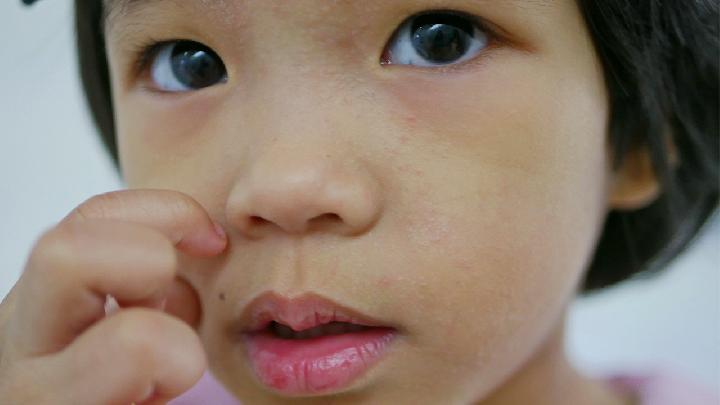 婴儿湿疹预防方法有哪些