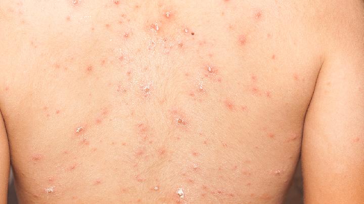 湿疹常见的类型有哪几种？