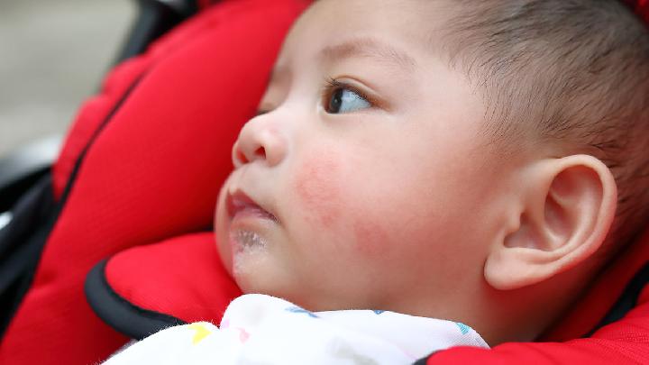婴儿患上湿疹后应该怎么护理好他们