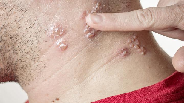 湿疹的常见病因