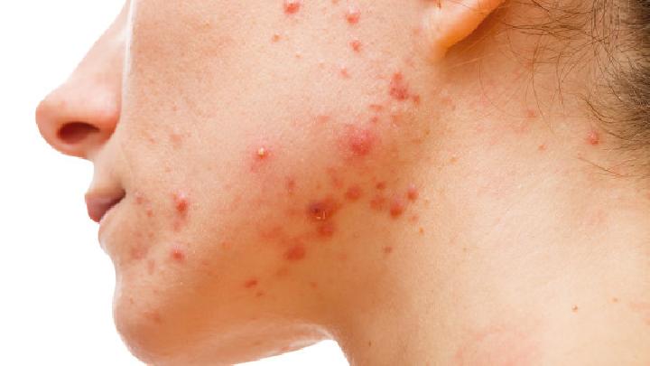 湿疹的症状有哪些？