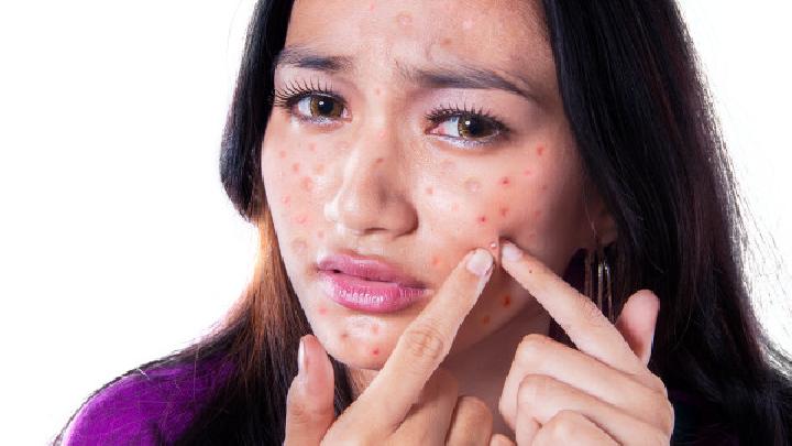 家庭防治湿疹的方法