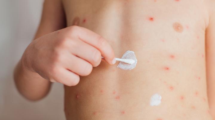 湿疹主要会出现什么症状呢