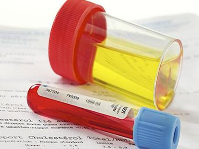 如何预防蛋白尿_蛋白尿的早期预防_蛋白尿预