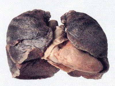 肺结核的诊断标准_如何诊断肺结核_肺结核的