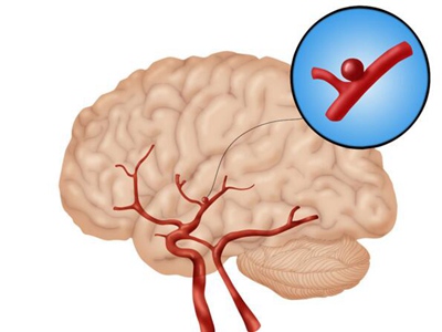 早期腦血管痙攣怎麼辦