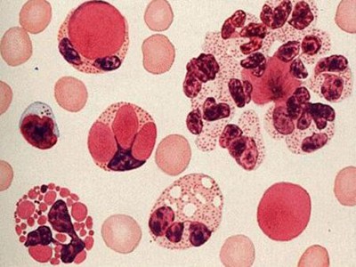 系统性红斑狼疮的诊断标准_如何诊断系统性红