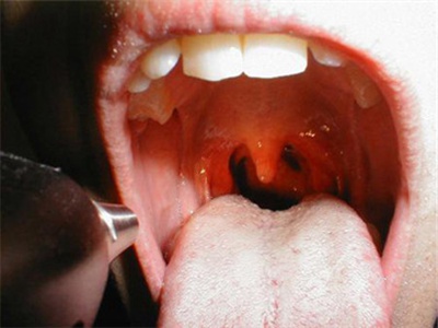 咽喉癌有什么症状图片