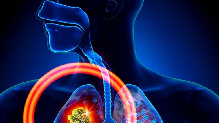 肺癌疾病的发病因素