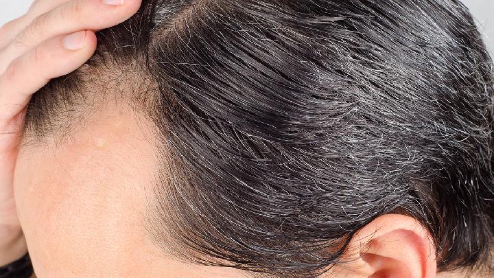 男性为什么容易秃顶男性秃头和6大因素有关