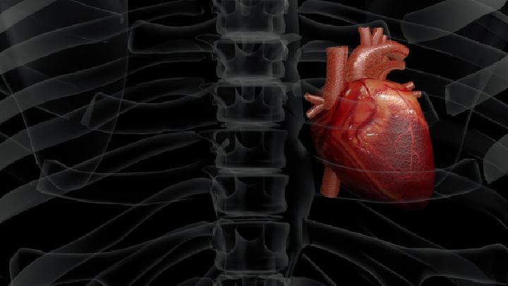 心肌梗塞并发左心室室壁瘤是什么?