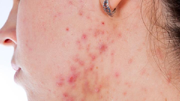 痤疮对患者的皮肤造成了哪些危害