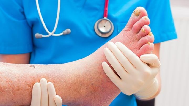 脚气的预防措施是什么
