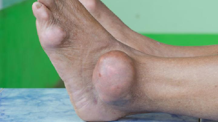 脚气治疗首要问题就是要消灭真菌