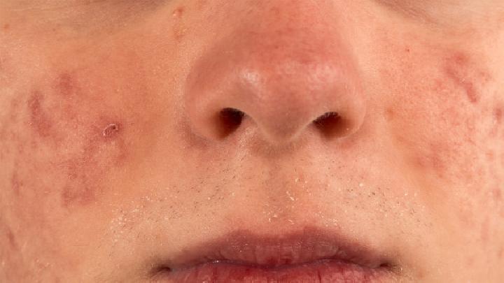 鼻部痤疮的症状有哪些