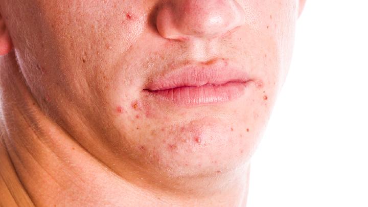 鼻部痤疮的症状有哪些