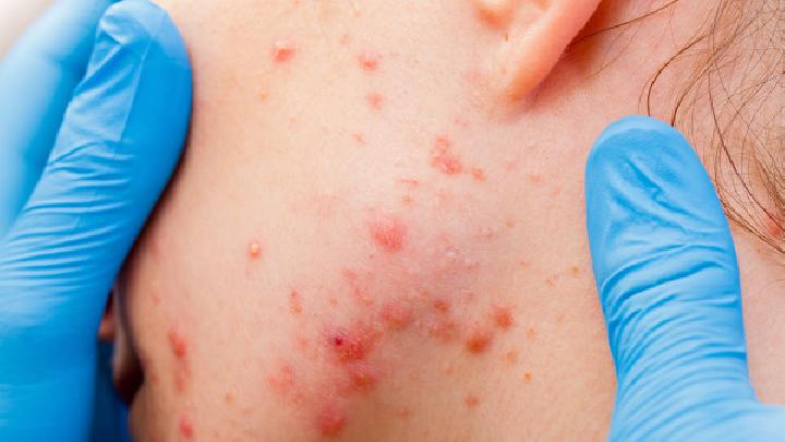 皮肤过敏会导致痤疮吗？