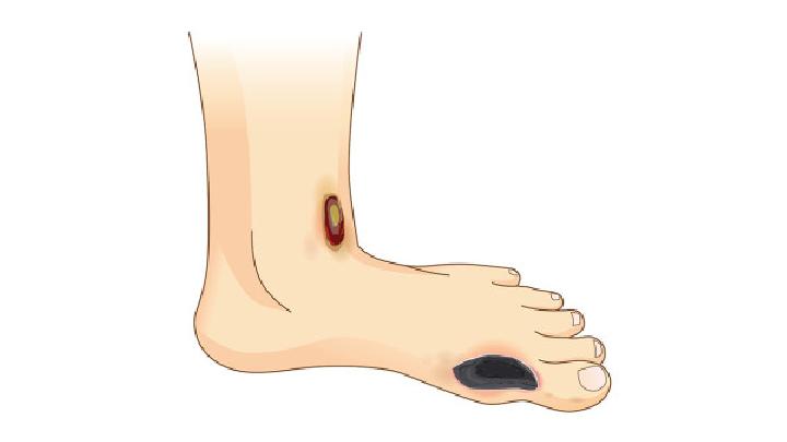 中医有效治疗脚气的八个小偏方