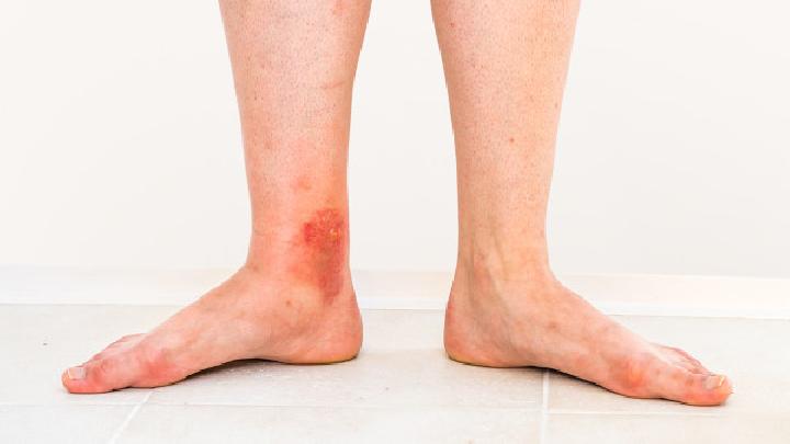 脚气会引发的多种并发症？