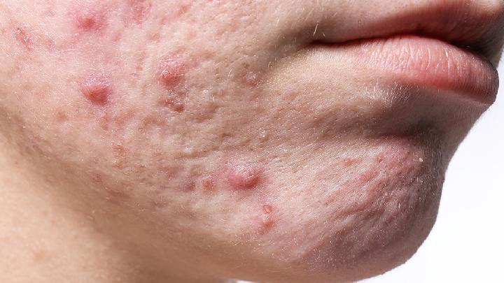 皮肤溃疡有哪些症状？