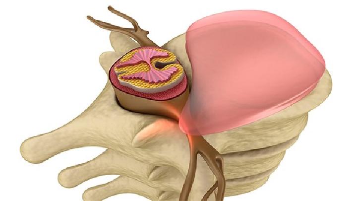 硬脊膜外脓肿的病因