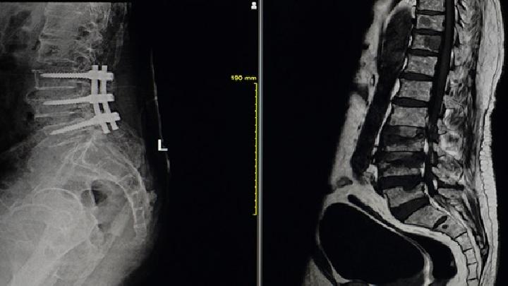 脊柱结核的诊断与鉴别