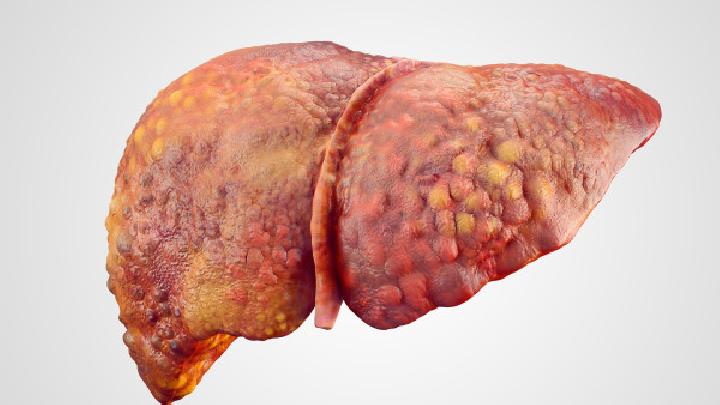 胆囊良性肿瘤该做哪些检查