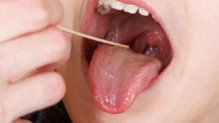 什么是急性舌扁桃体炎的症状