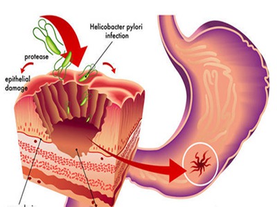 慢性浅表性胃炎表现症状会有哪些
