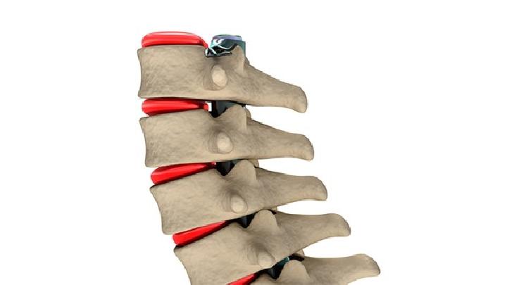 脊柱侧弯手术后需要注意什么