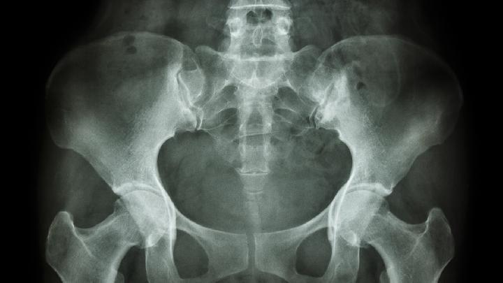 股骨粗隆间骨折有哪些表现及如何诊断？