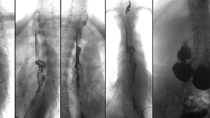 脊椎病的治疗方法有哪些