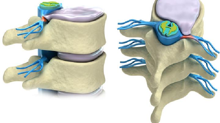 脊髓压迫症的病因及治疗方法