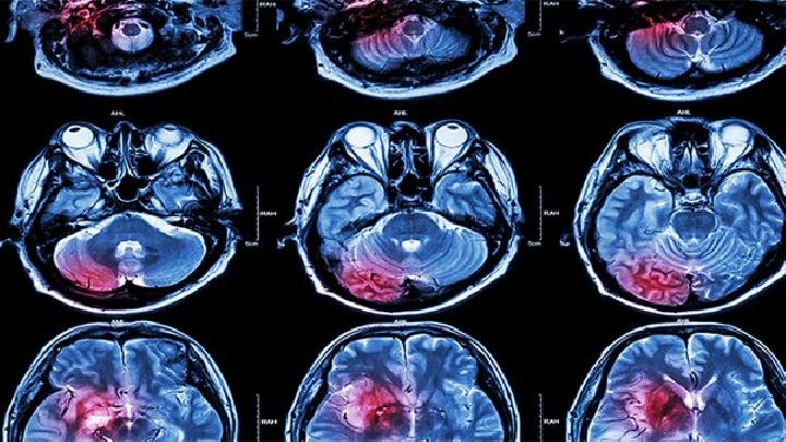 脑动脉硬化症能够预防吗？