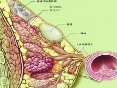 乳腺瘤的症状与图片图片