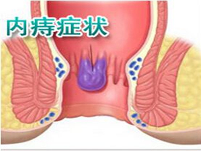 什么是外痔 o4YBAFpMbCiAXNH9AAEvsv87GPQ08.jpeg