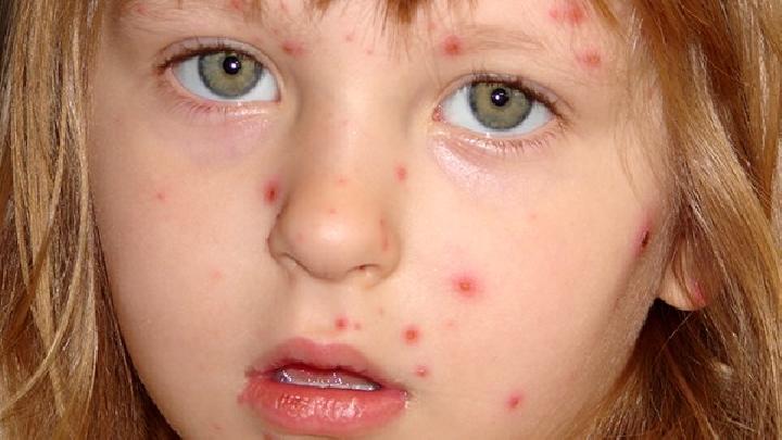 小孩皮肤过敏的症状都有哪些