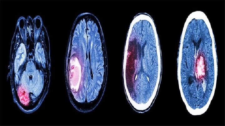 小脑幕脑膜瘤应该做哪些检查？